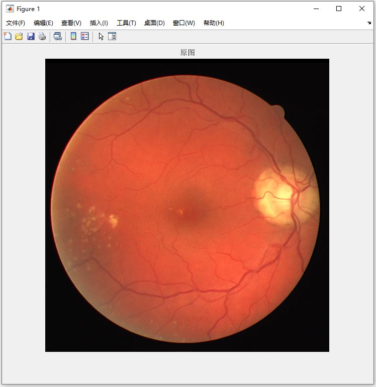 【B430】基于Matlab编写视网膜病变检测